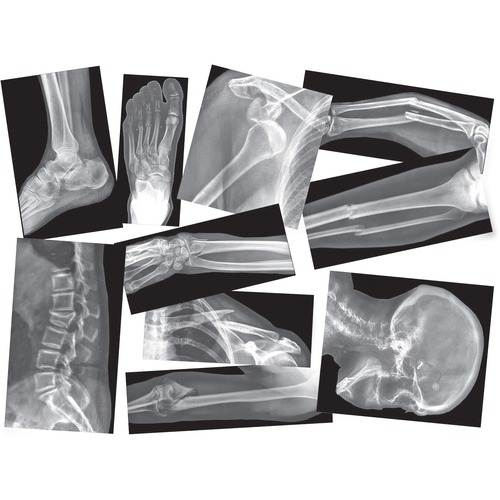 XRAY,BROKENBONES,15